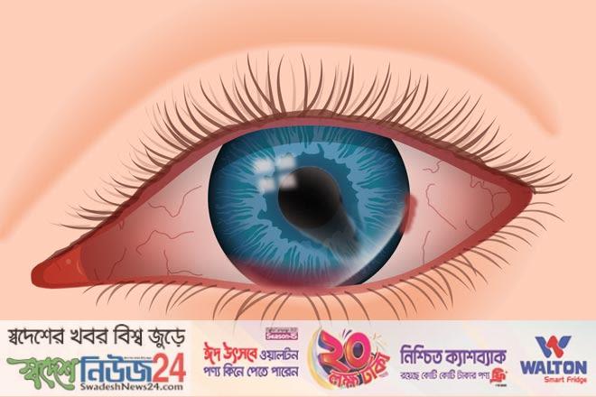 চোখে আঘাত পেলে কী করবেন 6 eye injury
